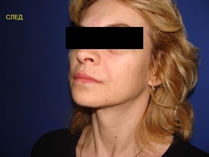 Mesotherapy with hyaluronic acid3.jpg